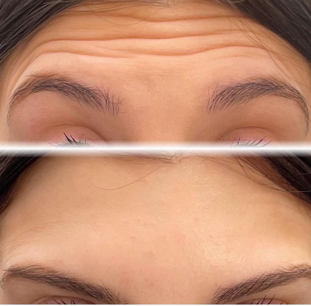 KIRIŞIKLIK TEDAVİSİ KIRIŞIKLIK AÇMA İŞLEMİ